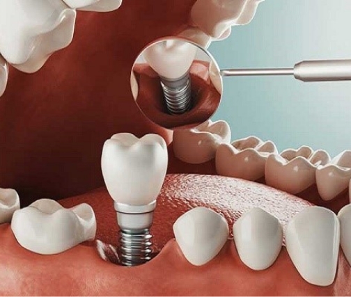 بهترین مرکز کاشت دندان - ایمپلنت