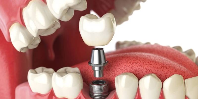 پروتز دندان در شهرکرد - کلینیک سلامت